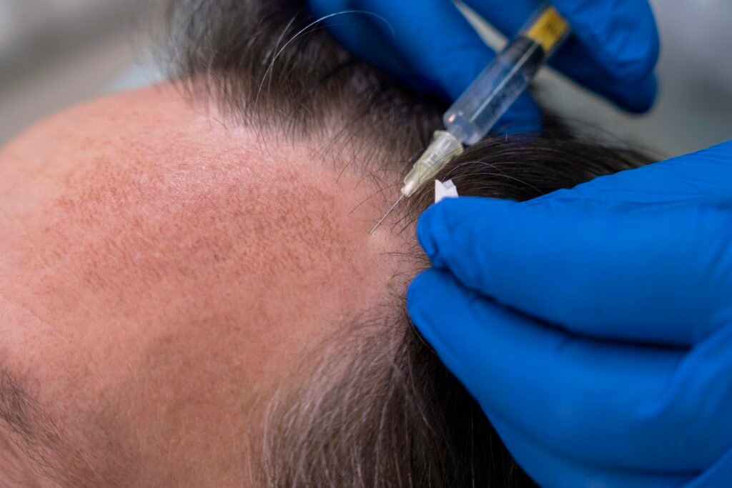 Mesoterapia capilar. Consulta de CDC Valladolid